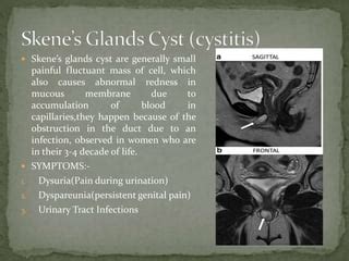 glande skene|Skenes Gland: What Theyre For, Cyst Symptoms & Treatment